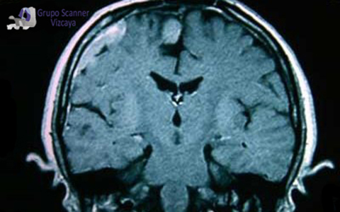 Resonancia Magnetica craneal