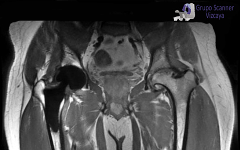 Resonancia Magnética de cadera