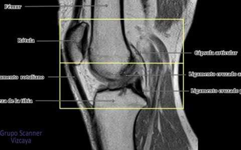 Resonancia Magnetica de rodilla