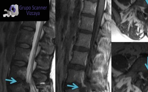 Resonancia Magnetica lumbar